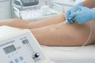 Carbossiterapia Novara