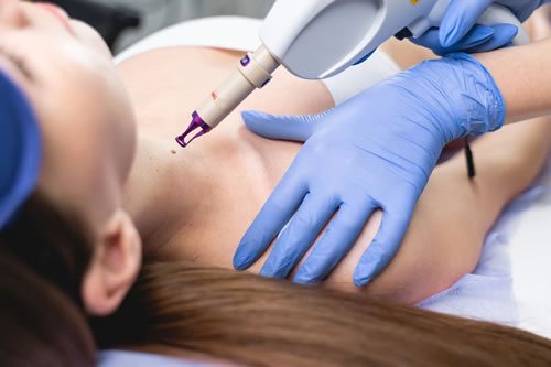 Laser al Plasma Novara