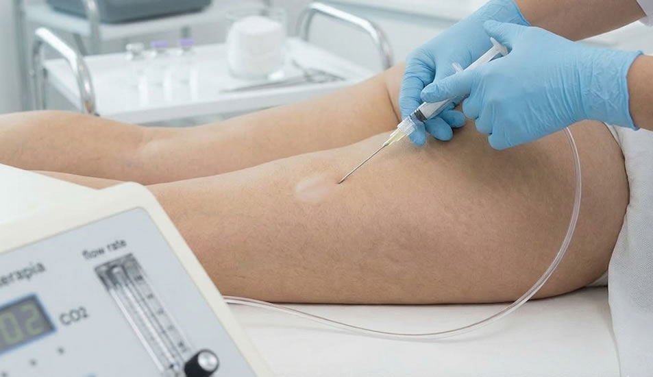 Carbossiterapia Novara